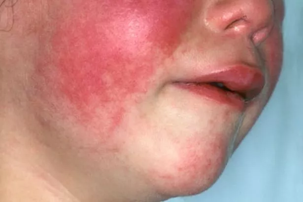 Scarlet fever on the rise: symptoms and what to do if it spreads to Huddersfield